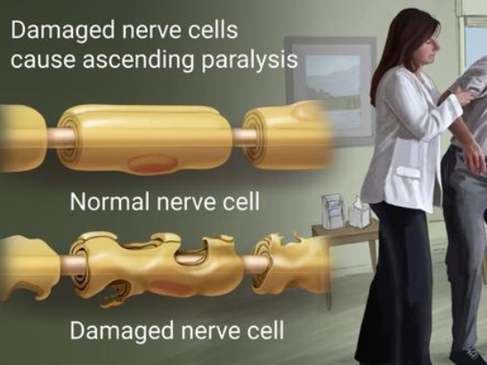 <p>Demyelination’s disorder in peripheral nervous systems </p><p></p>