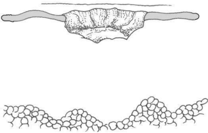 <p>Pérdida de la epidermis y de la membrana basal</p><p>Traumatismos, vasculitis, úlcera indolente felina</p>