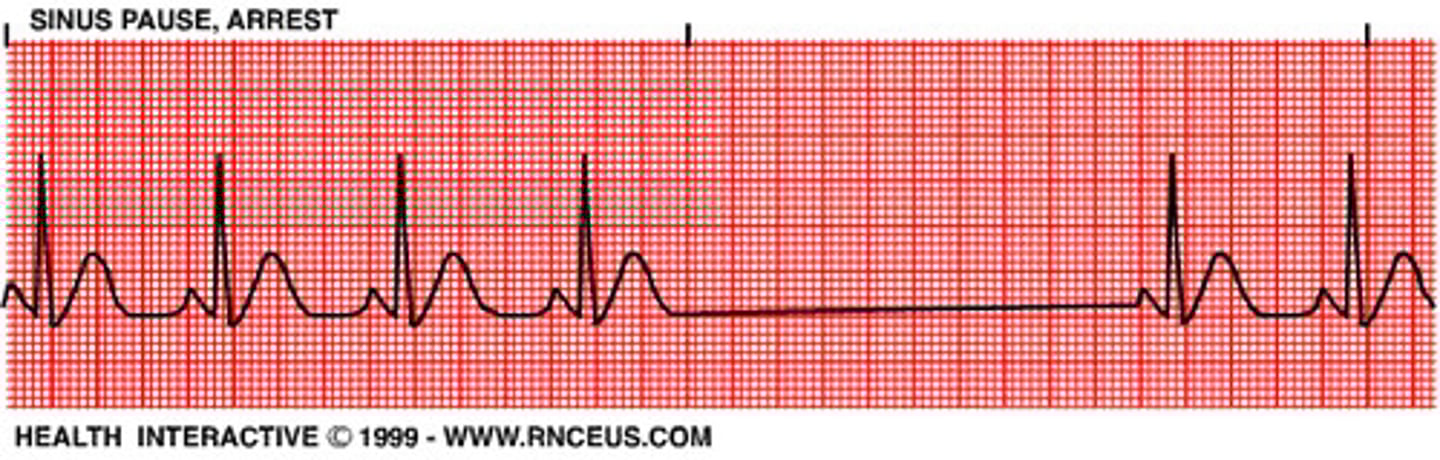 <p>- SA node doesn't fire</p><p>- notice absence of P-wave for a complete cycle (a missed cycle)</p>
