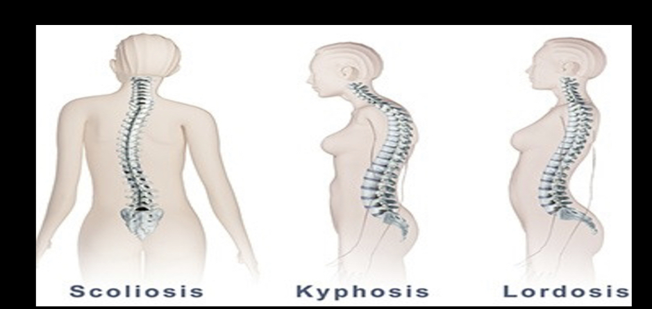kyphosis
Scoliosis
Lordosis