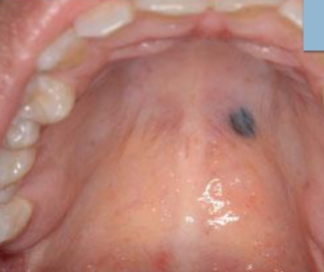 <p>develops during childhood, most common on HARD PALATE or GINGIVA</p>