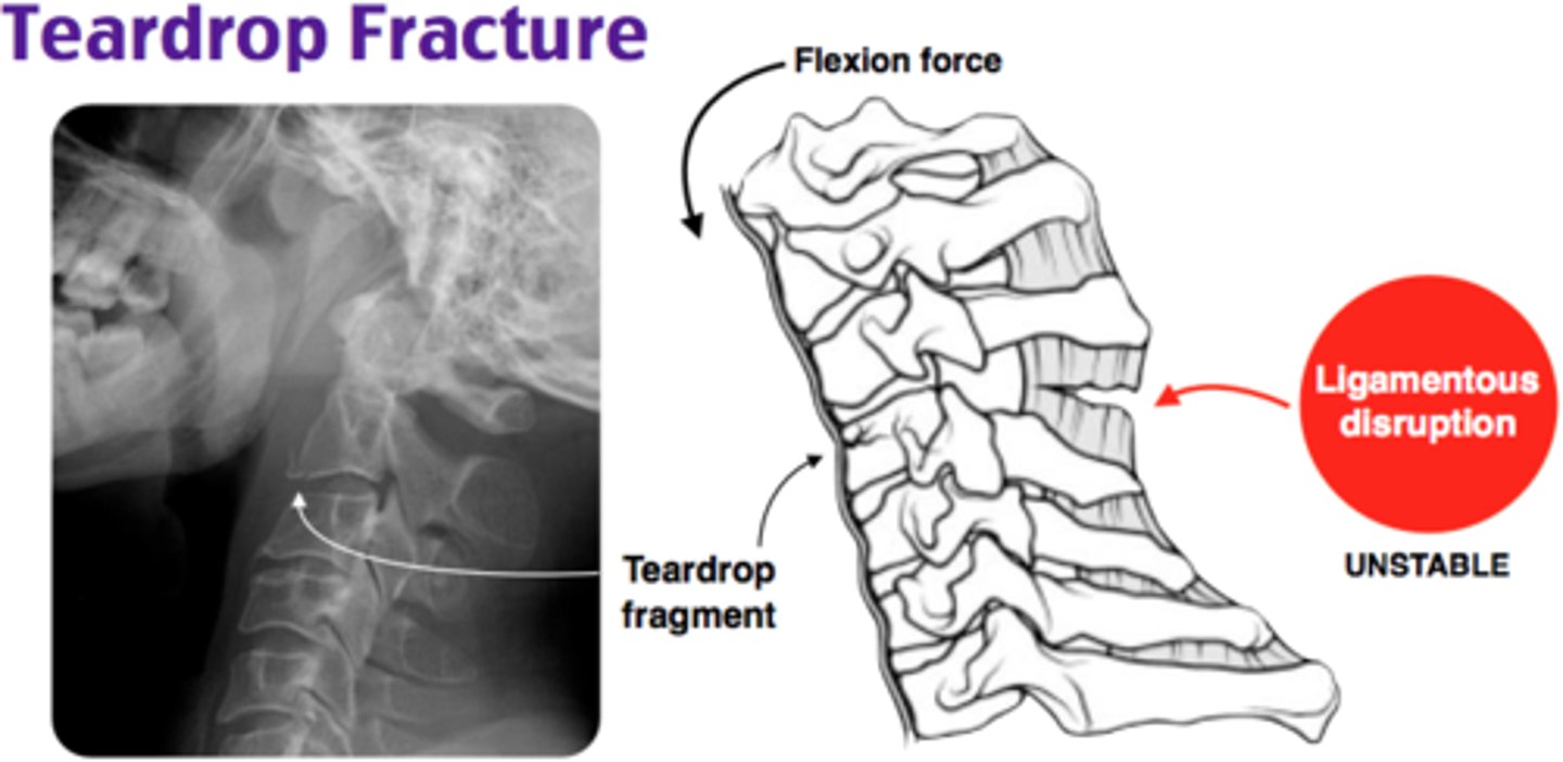 <p>Flexion Teardrop Fracture </p>