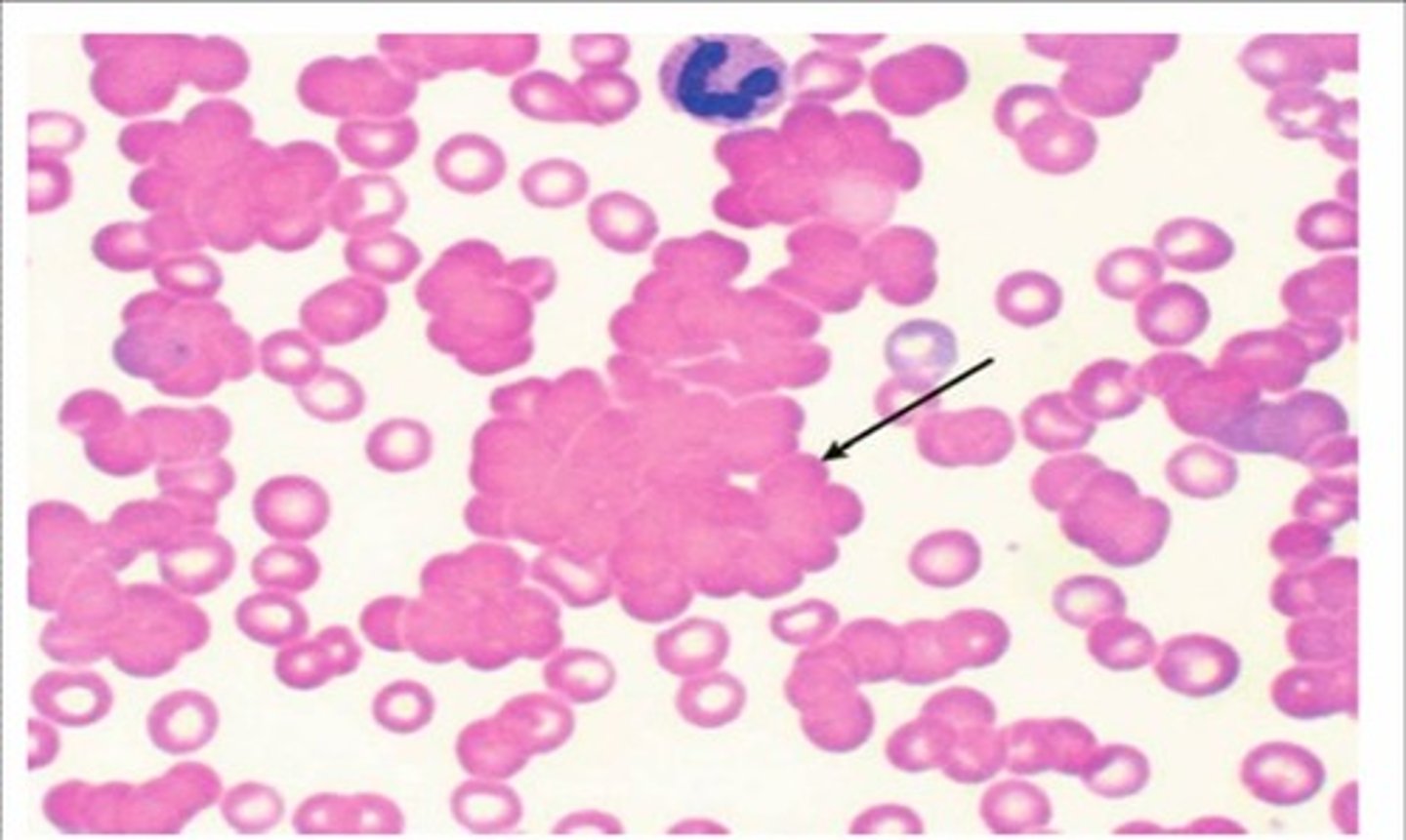 <p>Cold agglutinin disease (autoimmune hemolytic anemia caused by Mycoplasma pneumoniae, infectious mononucleosis, CLL)</p>