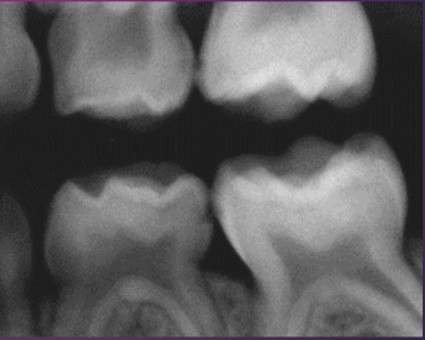 <p>what permanent tooth will replace primary tooth K?</p><p>a. #13</p><p>b. #19</p><p>c. #20</p><p>d. #21</p>