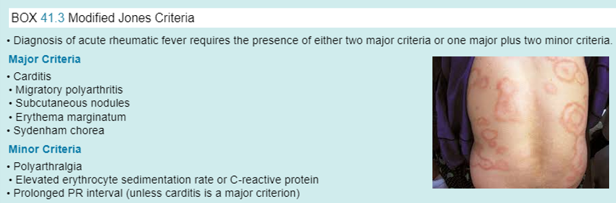 <p>The Diagnosis of Acute Rheumatic Fever requires the presence of either <strong>two major criteria</strong> <em>or </em><strong>one major <u>plus</u> two minor criteria</strong>.</p><ul><li><p><strong>Major Criteria:</strong></p><ul><li><p class="">Carditis</p><ul><li><p class="">inflammation of the heart.</p></li></ul></li><li><p class="">Migratory polyarthritis***</p><ul><li><p class="">multiple joints hurting moving around (not always the same one).</p></li></ul></li><li><p class="">Erythema marginatum**</p><ul><li><p class="">subcutaneous nodules under the skin (as shown in picture)</p></li></ul></li><li><p class="">Sydenham chorea</p><ul><li><p class="">CNS features; muscle weakness, falling, trouble speaking, etc.</p></li></ul></li></ul></li><li><p><strong>Minor Criteria:</strong></p><ul><li><p class="">Polyarthralgia**</p><ul><li><p class="">multiple areas that hurt (doesn’t necessarily moves around)</p></li></ul></li><li><p class="">Elevated ESR or CRP</p></li><li><p class="">Prolonged PR interval (unless carditis is a major criterion)</p></li></ul><p></p></li></ul><p>“Joint pain, chest pain, and a ‘funny rash’ with reported sore throat a month ago…”</p>