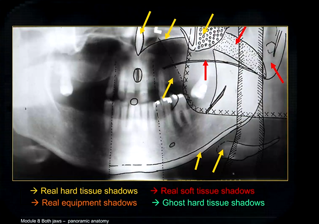 <p>real soft tissue shadows of the soft palate, ear lobe and the dorsum of the tongue </p>