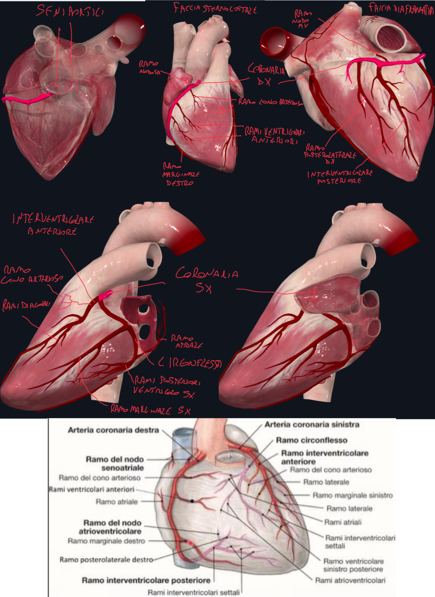 <p>La vascolarizzazione del cuore è affidata alle ARTERIE CORONARIE, che originano dai SENI AORTICI, dietro le cuspidi della valvola aortica </p><ul><li><p>L’infarto miocardico è dovuto alla mancanza di apporto ematico al miocardio</p></li></ul><p>Arteria Coronaria Destra:</p><ul><li><p>Origina dal Seno Aortico Destro</p></li><li><p>Decorso → in avanti tra tronco polmonare e auricola destra, poi prosegue nel solco atrioventricolare destro (solco coronario) e raggiunge il margine acuto del cuore per poi continuare sulla faccia diaframmatica</p></li><li><p>Rami che emette sulla faccia sternocostale:</p><ul><li><p>Ramo del Cono Arterioso (sulla parete ventricolo dx, porzione di efflusso)</p></li><li><p>Ramo del Nodo Senoatriale (nella maggior parte dei casi)</p></li><li><p>Rami Atriali</p></li><li><p>Rami Ventricolari Anteriori</p></li><li><p>Ramo Marginale destro (o arteria del margine acuto)</p></li></ul></li><li><p>Rami che emette sulla faccia diaframmatica:</p><ul><li><p>Raggiunto il crux cordis origina:</p></li><li><p>Arteria Interventricolare Posteriore (invia rami settali per 1/3 posteriore del setto) e Ramo Posterolaterale destro che decorrono nel solco interventricolare posteriore </p></li><li><p>Ramo del Nodo Atrioventricolare</p></li></ul></li><li><p>Quindi la coronaria destra vascolarizza entrambi i pacemaker</p></li></ul><p>Arteria Coronaria Sinistra:</p><ul><li><p>Origina dal Seno Aortico Sinistro</p></li><li><p>Decorso → in avanti tra tronco polmonare e auricolare di sinistra, per poi dividersi subito in:</p><ul><li><p>Arteria Interventricolare Anteriore e Arteria Circonflessa</p></li></ul></li><li><p>Arteria Interventricolare Anteriore → nel solco interventricolare anteriore fino a raggiungere l’apice del cuore dove incontra quella posteriore. I suoi rami sono:</p><ul><li><p>Ramo del cono arterioso che può anastomizzare con il ramo del cono arterioso della coronaria dx</p></li><li><p>Rami diagonali verso il ventricolo sx (sono tre e li chiamiamo LAD, arteria discendente anteriore sinistra)</p></li><li><p>Rami settali che penetrano nel setto (vascolarizza 2/3 anteriori del setto)</p></li></ul></li><li><p>Arteria Circonflessa → decorre sotto l’auricola sinistra e prosegue lungo il solco atrioventricolare. I suoi rami sono:</p><ul><li><p>Ramo Marginale Sinistro</p></li><li><p>Rami Posteriori del Ventricolo Sinistro</p></li><li><p>Ramo Atriale</p></li><li><p>In una minoranza dei casi emette ramo del nodo SA e AV, che però generalmente vengono dalla destra.</p></li></ul></li></ul><p></p>