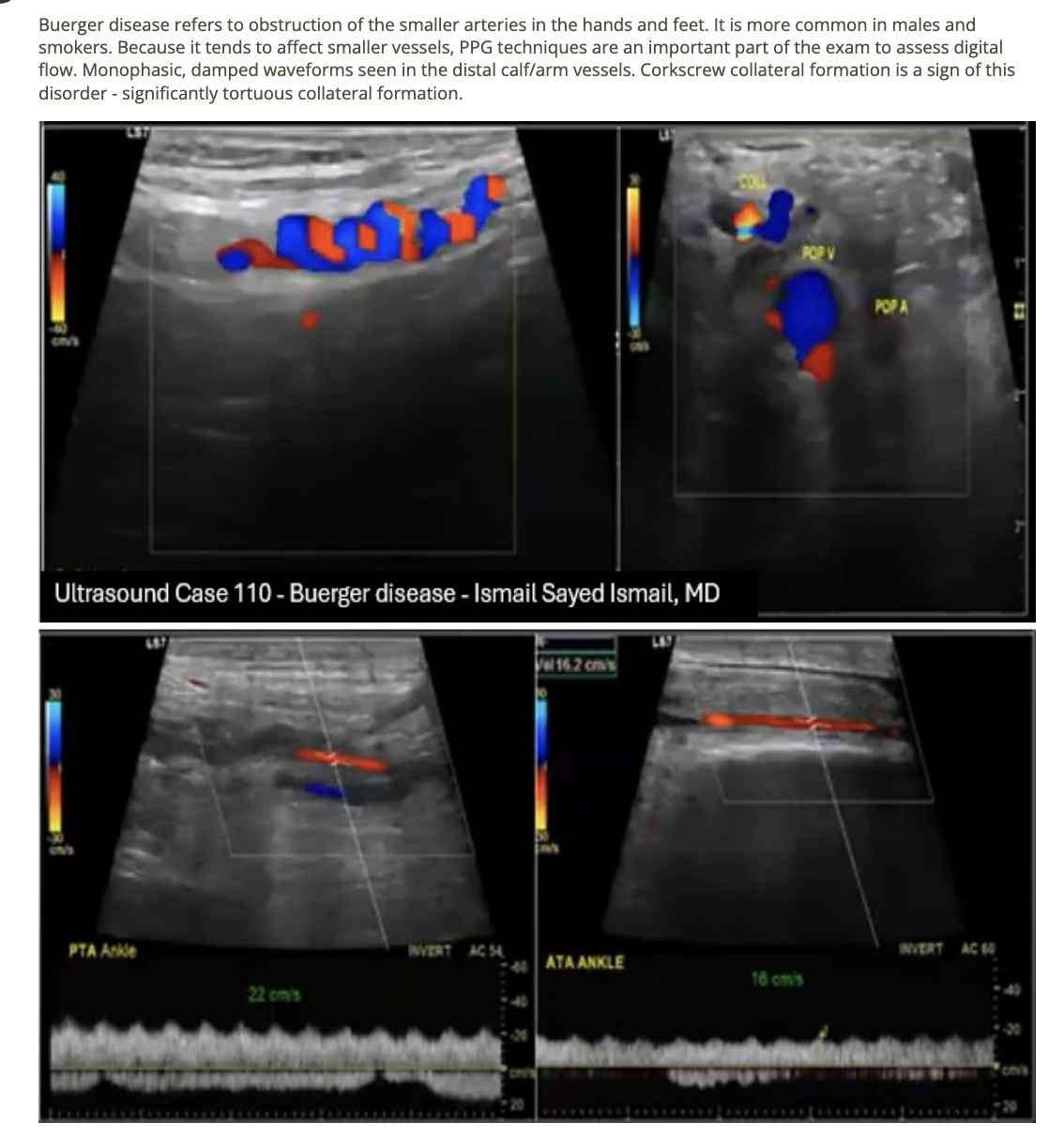 <p>c) smaller arteries of arm w/duplex + PPG</p>