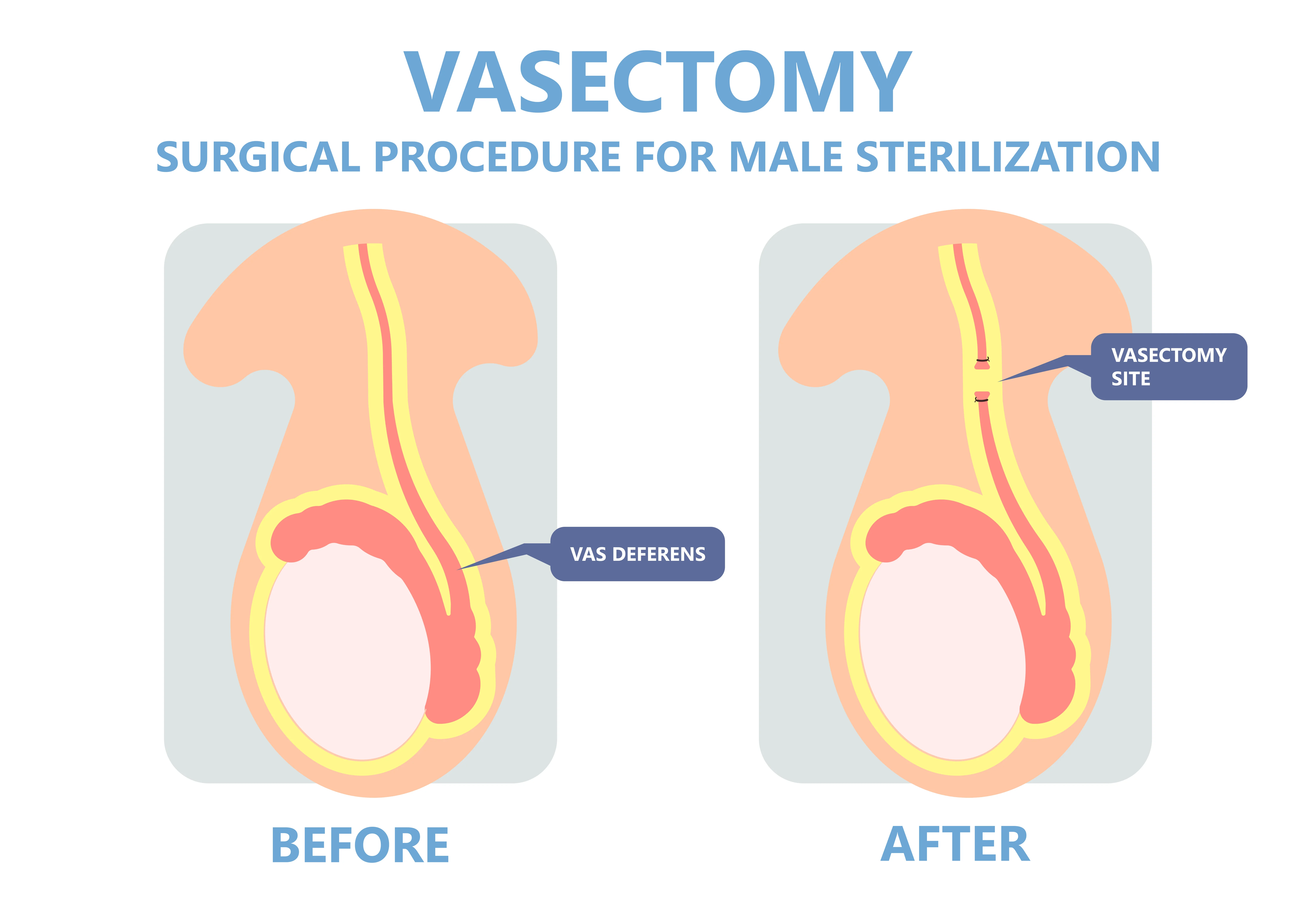 <p>surgical procudure consisting if ligation and severeance of the vas defenrs, ehich prevents sperm from traveling </p>