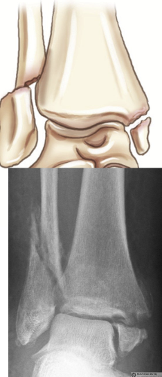 <p>Complete fracture of distal fibula, may involve ligament damage and fracture of medial malleolus and distal tibia</p>
