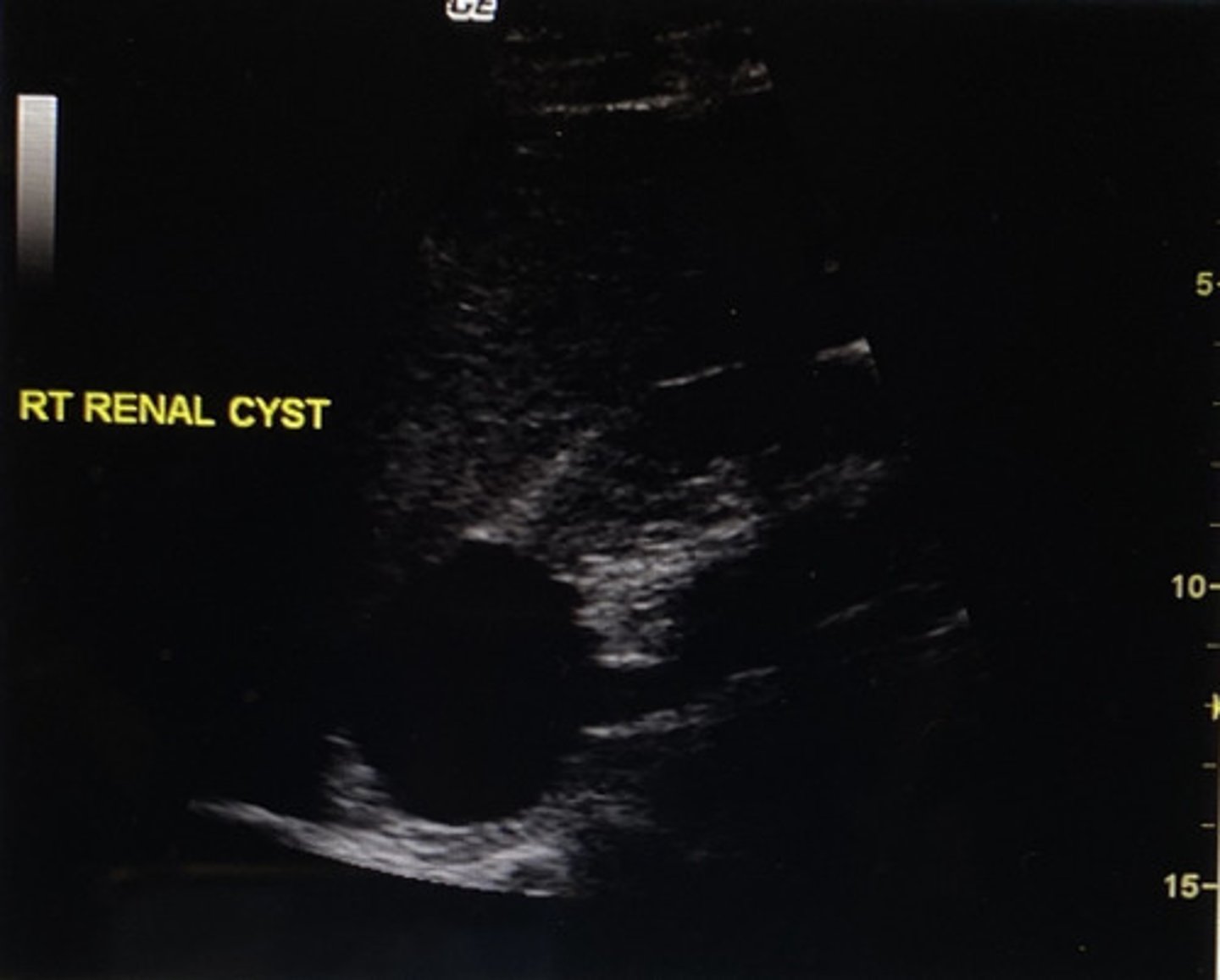 <p>A) superior pole of the right kidney</p>