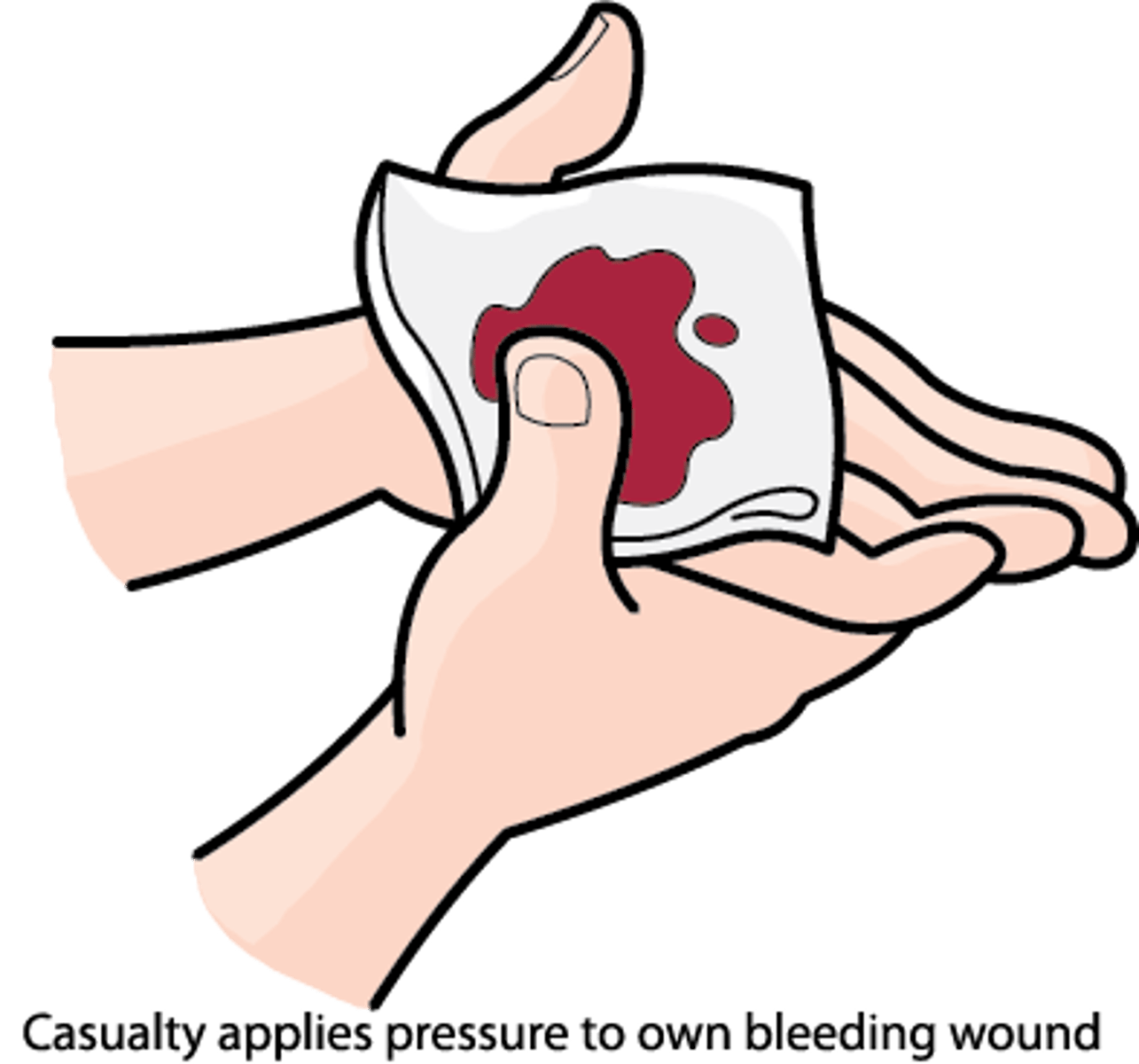 <p>Active bleeding (stop with alginate 24h or xeroform gauze)</p>