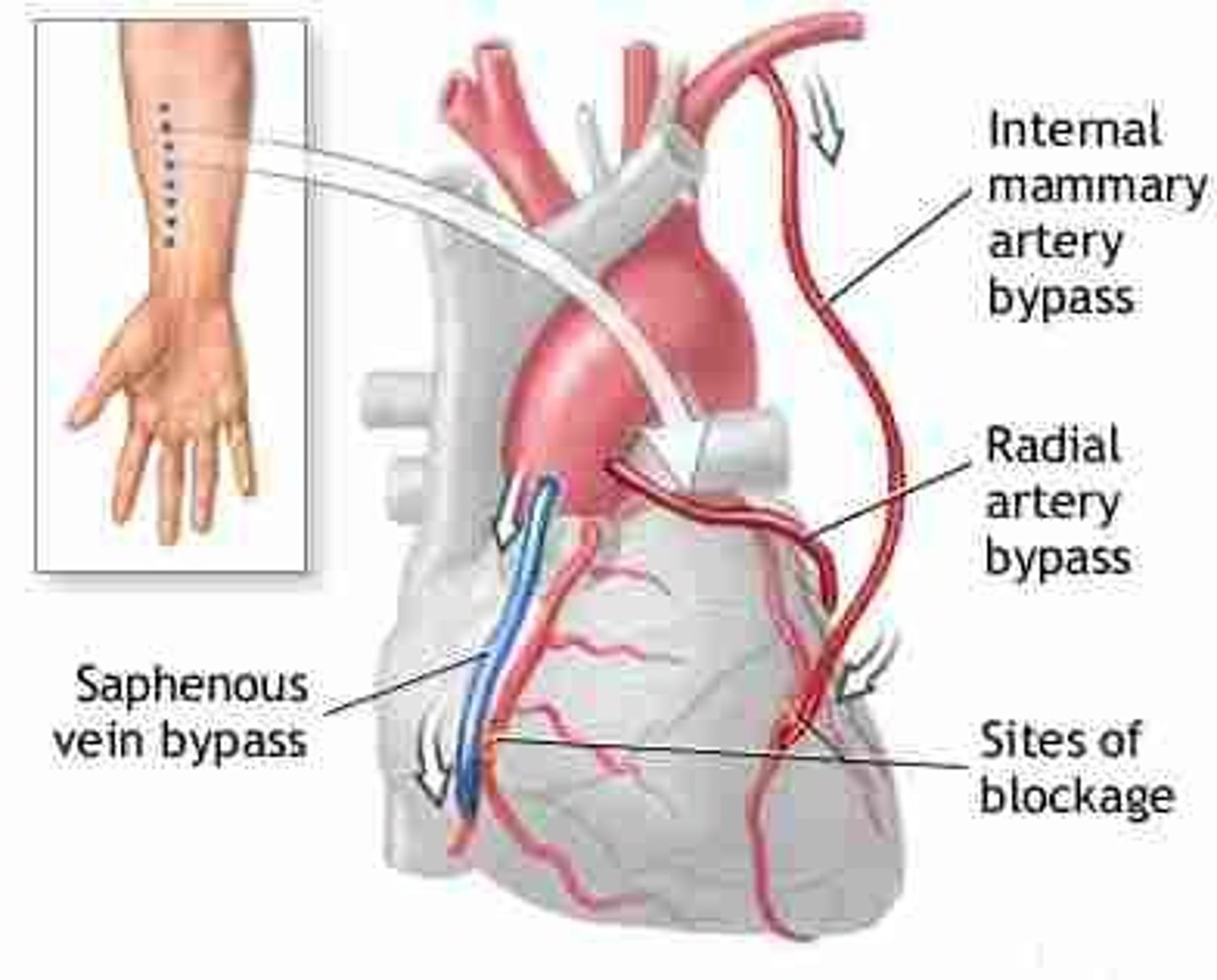 <p>Coronary Artery Bypass Graft, "Open heart surgery"</p><p>used only when PCTA cannot be used: significant occlusions in multiple areas</p><p>can be a single or multiple bypass</p>