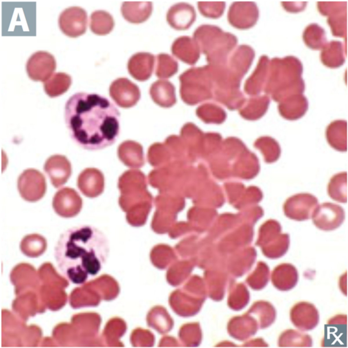 <p>In cold reactive autoantibodies, we see in increase in what?</p>