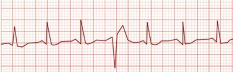 <p><span>During gait training with a patient, a physical therapist assistant notices the change in the electrocardiogram shown in the photograph. Which action should the assistant take?</span></p>