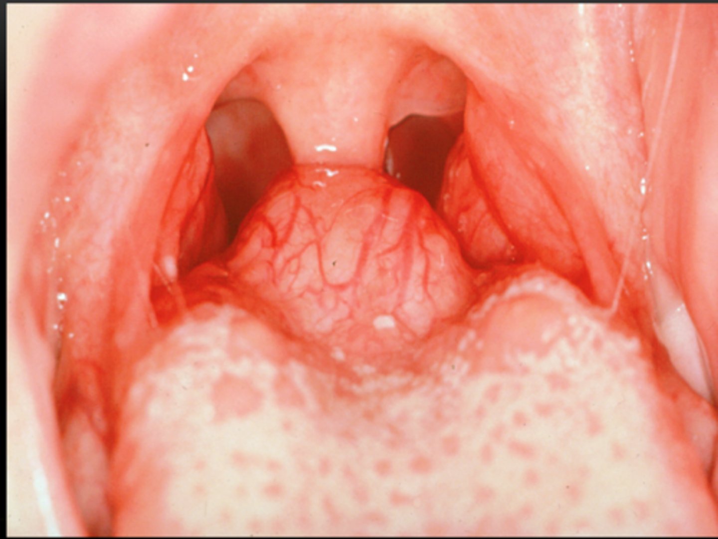 <p>cause = hypertrophy of thyroid tissue @ foramen cecum</p><p>effect = dysphagia, dyspnea, dysphonia</p><p>tx = do NOT remove, TH hormones</p>