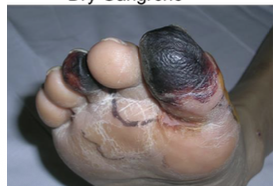 <p>Dry gangrene (Form of Necrosis)</p>