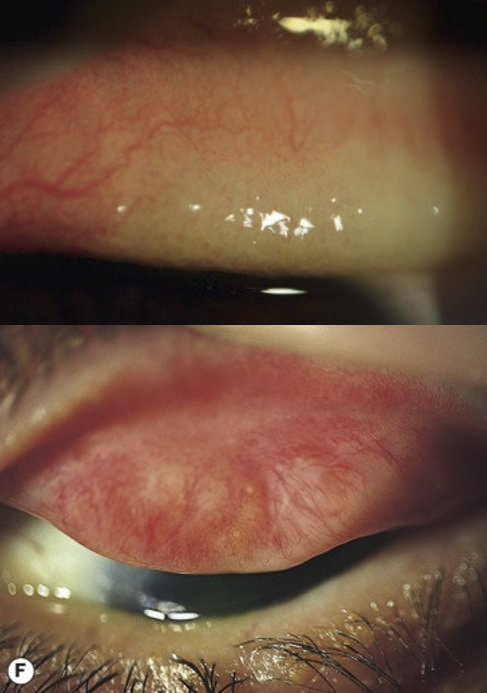 <ul><li><p>Infiltration:</p><ul><li><p>Linked to chronic inflammation and papillary response</p></li><li><p>Loss of conjunctival detail</p></li><li><p>Commonly affects the superior tarsal plate</p></li></ul></li><li><p>Subconjunctival Scarring:</p><ul><li><p>Frequently seen in trachoma</p></li><li><p>Severe scarring leads to loss of goblet cells and accessory lacrimal glands</p></li><li><p>Can result in entropion (inward turning of the eyelid)</p></li></ul></li></ul><p></p>