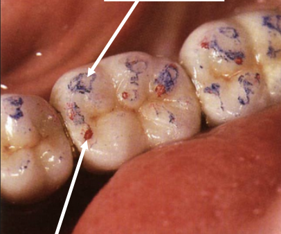 <p>Arrows point at?</p>