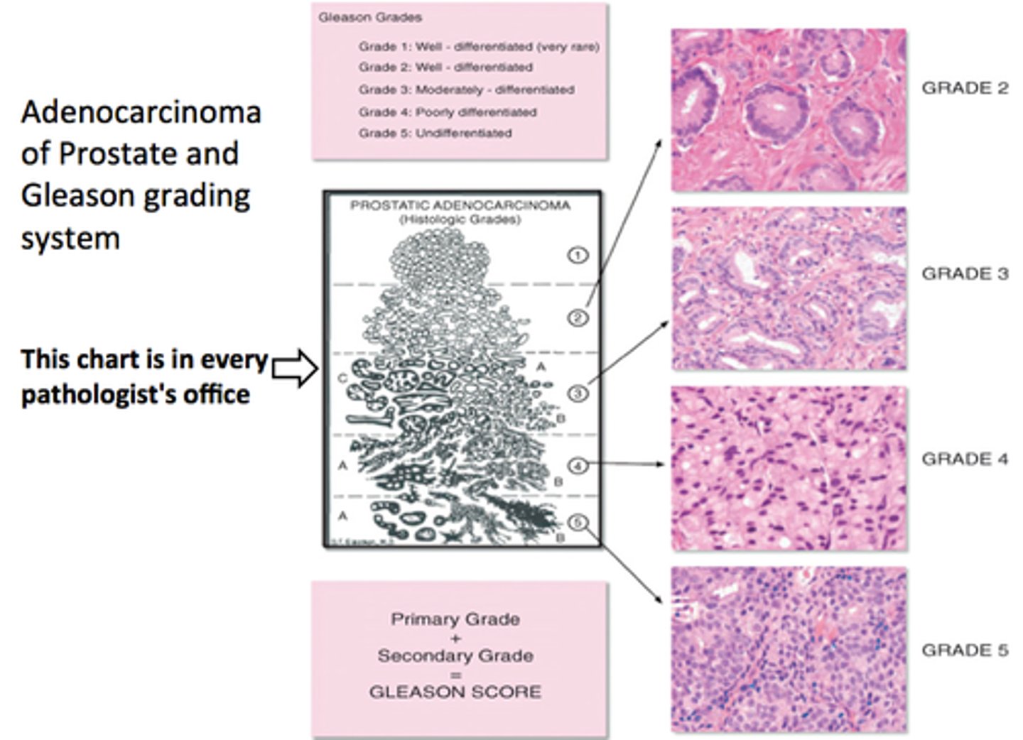 <p>Appearance: Mostly fused messy glands; Treatments: External Beam Radiation, Hormone Therapy.</p>