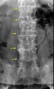 <p>a variant of rheumatoid arthritis and an inflammatory disease that, over time, can cause some of the bones in the spine, called vertebrae, to fuse. This fusing makes the spine less flexible and can result in a hunched posture. If ribs are affected, it can be difficult to breathe deeply.</p>