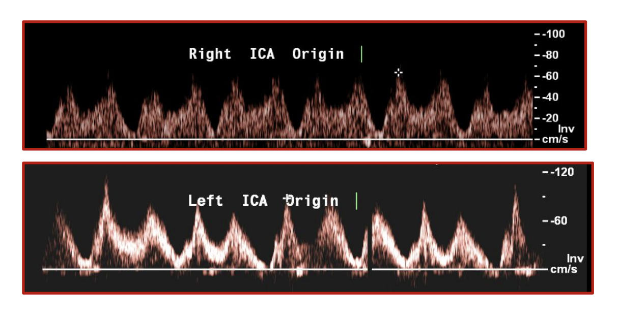 <p>You see this waveform on a patient with a preop carotid duplex scan, how would you describe it.</p>