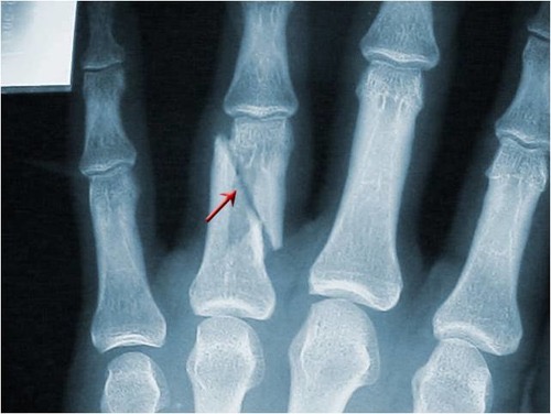 <p>Oblique fracture</p>