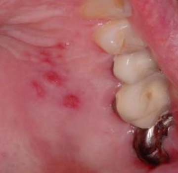 <p>Where do intra-oral recurrent herpes lesions occur?</p>