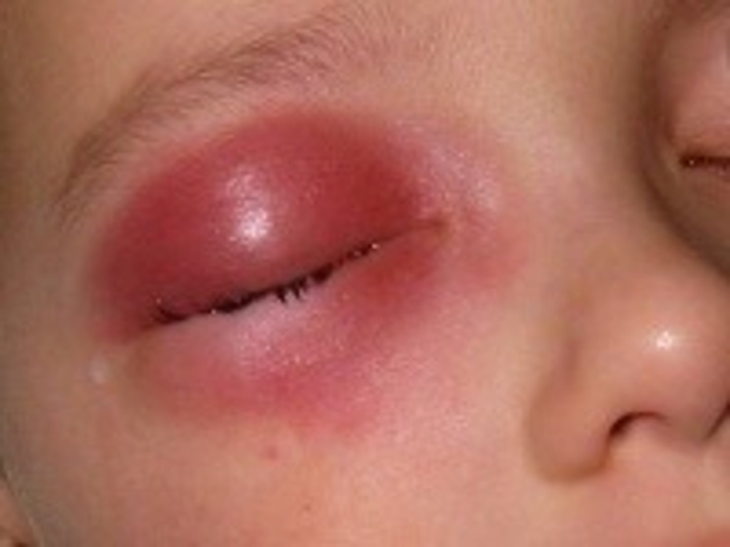 <p>7-12 y/o</p><p>Strep or H. influenzae B</p><p>Fever, proptosis, ↓ EOM, Swelling and redness</p><p>Dx: CT</p>