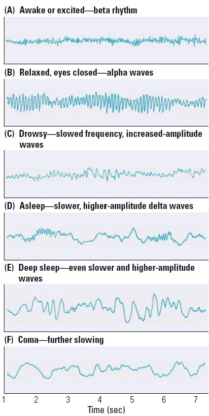 * low amplitude and high frequency
* known as beta rhythm