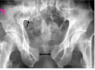<p><strong>Pelvic Fractures: Physical Exam and Diagnosis </strong></p><p>-PE</p><ul><li><p>______ first!</p></li><li><p>Look for → external ________, ecchymosis, blood at _______, vaginal/rectal bleeding, position of LE and iliac crest </p></li><li><p>Full ______/_________ exam to look for blood and bruising</p></li><li><p>____________ of pelvic to check for instability </p></li></ul><p>-Diagnosis</p><ul><li><p>X-ray is the textbook initial test, while __ is the essential test for diagnosis </p></li><li><p>Possibly vascular and/or urologic imaging </p></li></ul><p></p>