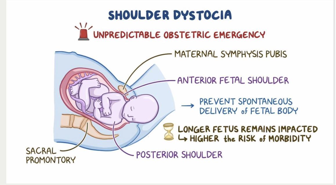 <p>occurs when, <strong>after the fetal head is delivered</strong>, <strong>one or both shoulders get stuck behind the maternal pubic symphysis</strong>, preventing the rest of the baby from being delivered spontaneously.</p><ul><li><p>This is an <strong>obstetric emergency</strong> because the baby can suffer from hypoxia if delivery is delayed.</p></li><li><p>Usually occurs <strong>after head delivery</strong> but <strong>before the body comes out</strong>.</p></li></ul><p><strong>risk factors</strong></p><ul><li><p>large for GA baby&nbsp;</p></li><li><p>diabetes&nbsp;</p></li></ul><p><strong>maternal complications</strong></p><ul><li><p>3-4th degree lacertaion</p></li><li><p>postpartum hemorrhag</p></li></ul><p></p><p><strong>fetal complications</strong></p><ul><li><p>fractures clavicle / humerus</p></li><li><p>brachial plexus nerve injury</p></li><li><p>asphyxia / death</p></li></ul><p></p>