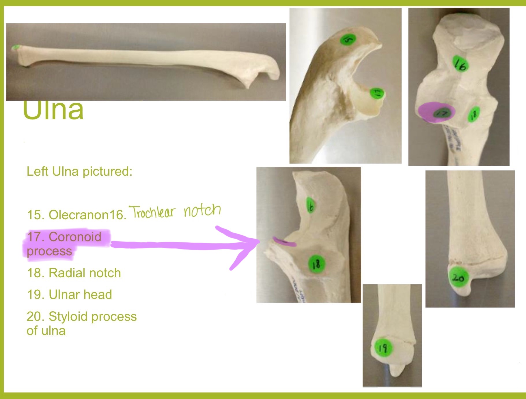 <p>coronoid process of ulna</p>
