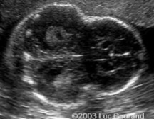 <ol><li><p>What is abnormal about this image?</p></li><li><p>This finding can be associated with what pathology?</p></li></ol><p></p>
