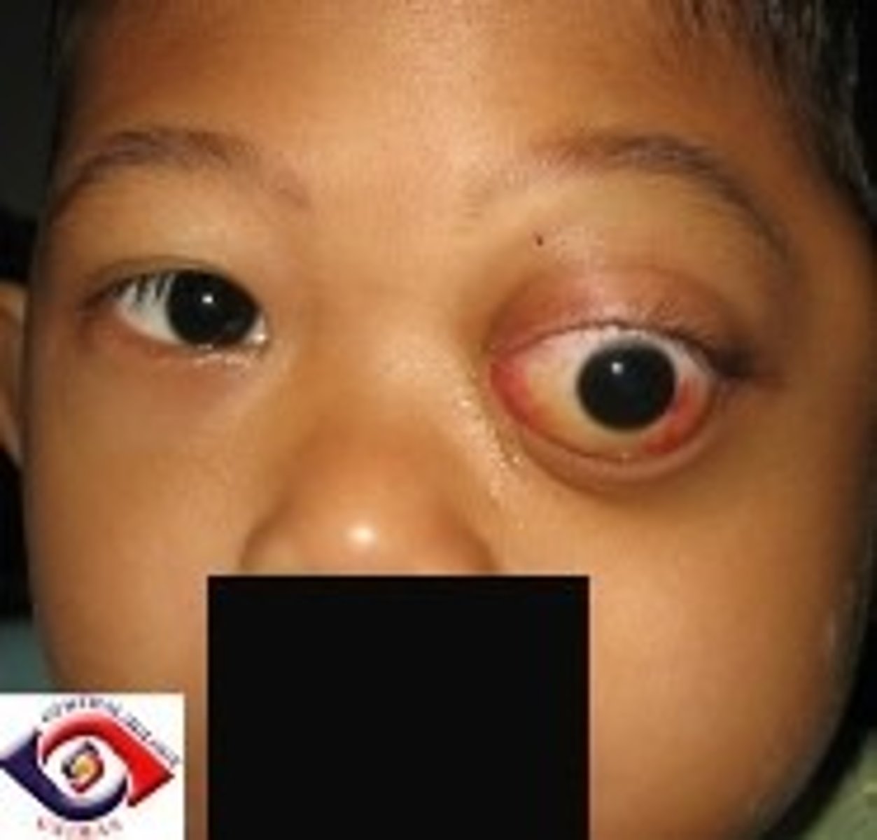 <p><u>Etio</u>: <strong>rare</strong> tumor, children</p><p><u>S&amp;S:</u> <strong>unilateral proptosis</strong>, lid edema, vision loss, nontender mass</p><p><u>Testing</u>: CT usually shows boney involvement, complete work-up for metastases</p><p><u>Tx</u>: urgent consult pediatric ophthalmologist &amp; oncologist</p>