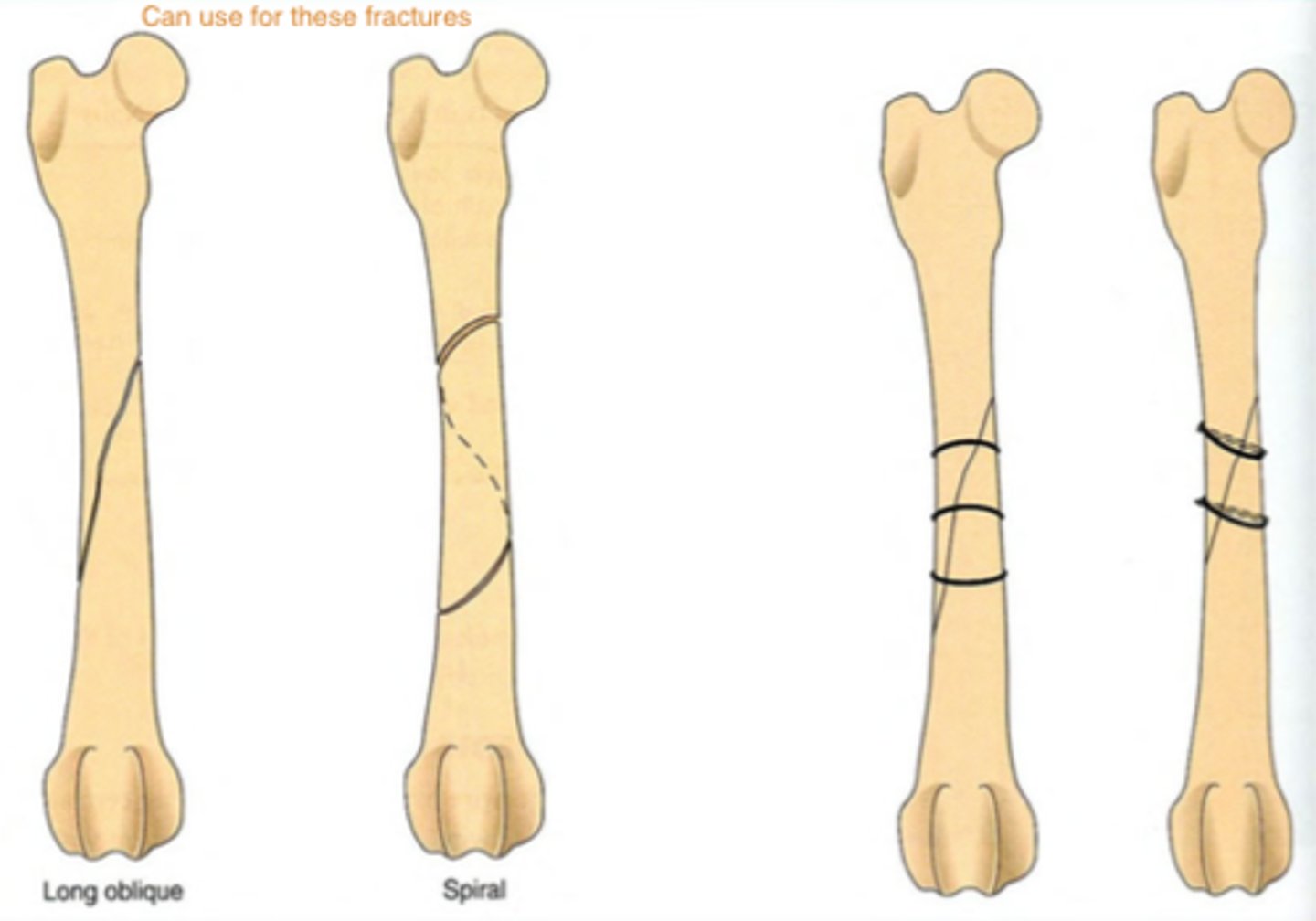 <p>draw fragments to normal position and fix them relying on circular cross section of bone to produce stability</p>