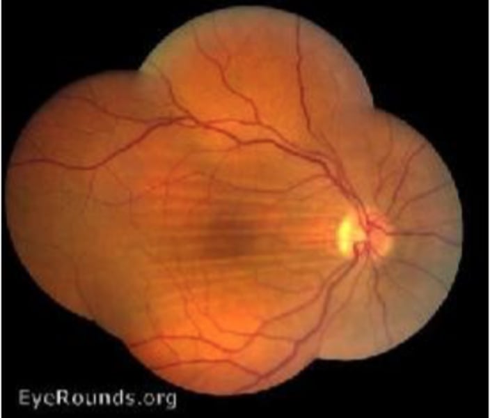 <p>grooves involving the inner choroid, Bruchs and RPE<br>-retinal vessels not apart of <br>-classic appearance of alternating yellow/dark bands in retina</p>