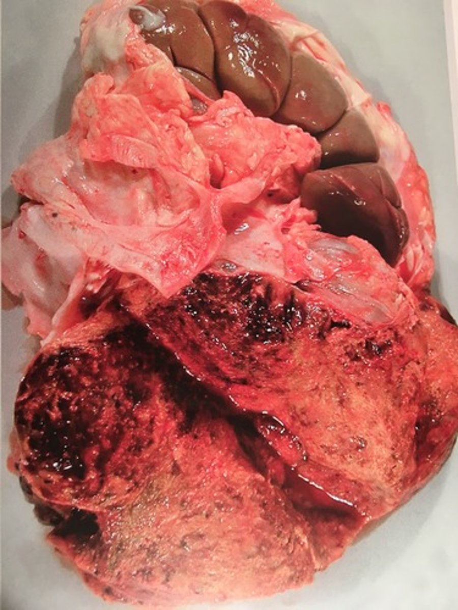 <p>adrenal kirtel (binyrer) og lever fra kvæg, hvad er den patoanatomiske diagnose?</p>