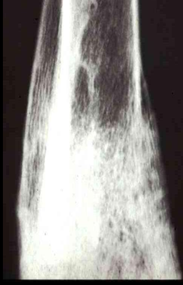 <p>What type of periosteal reaction?</p>
