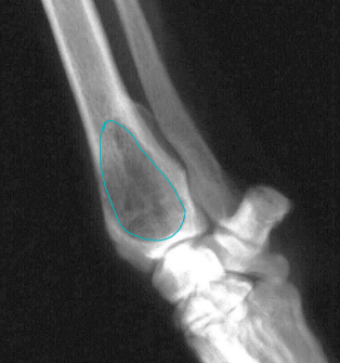 <p>Benign Bone Cysts</p>