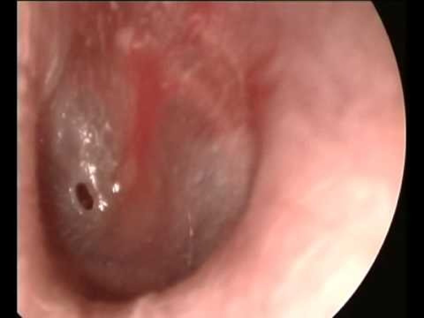 <p>A hole in the ear drum. may result from infection and rupture of the tympanic membrane due to build up of infected fluid or traumatic damage to the tympanic membrane.</p>