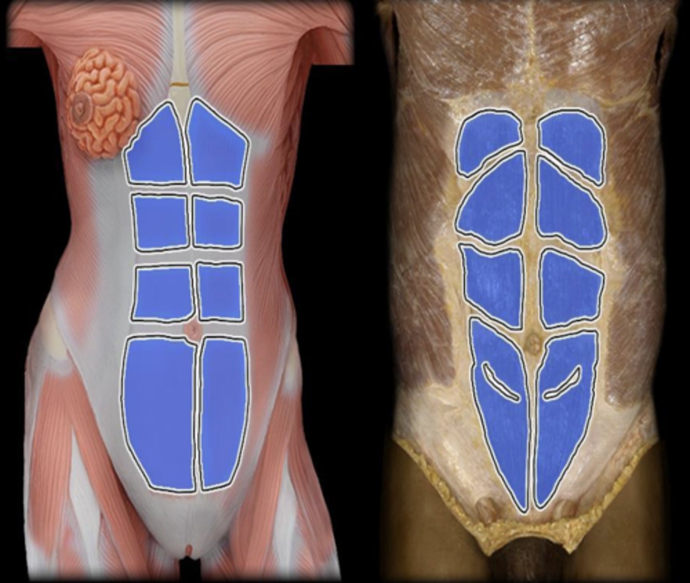 <p>action of rectus abdominus</p>