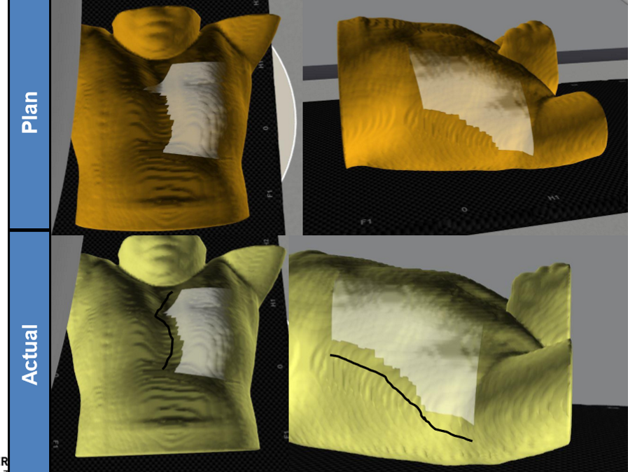<p>assume the patients A/P is set properly, what is the positioning error? what impact does it have on the lung volume treated?</p>
