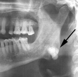 <p>A benign bone tumor that continues to grow (vs. exostosis)</p>