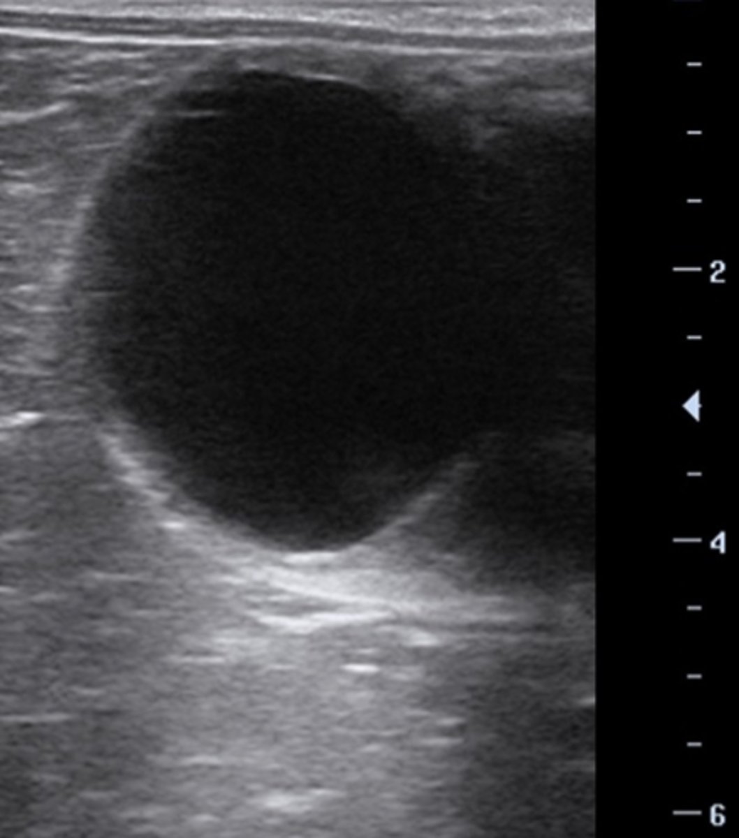 <p>Ved ultralydsscanning af en hoppes ovarie fandtes denne struktur på 38 mm, et corpus luteum og intet endometrieødem. Hvilken af følgende muligheder vil du vælge?</p><p>- Du bestiller sæd og inseminerer hurtigst muligt.</p><p>- Hoppen har en haemorrhagisk follikel og du venter 21 dage med at inseminere</p><p>- Hoppen har en diøstral follikel og du vil ikke inseminere nu</p><p>- Du giver hCG og inseminerer om 48 timer</p>