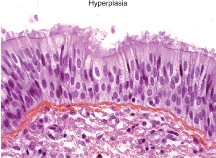 <p>hyperplasia of bronchial epithelium</p>