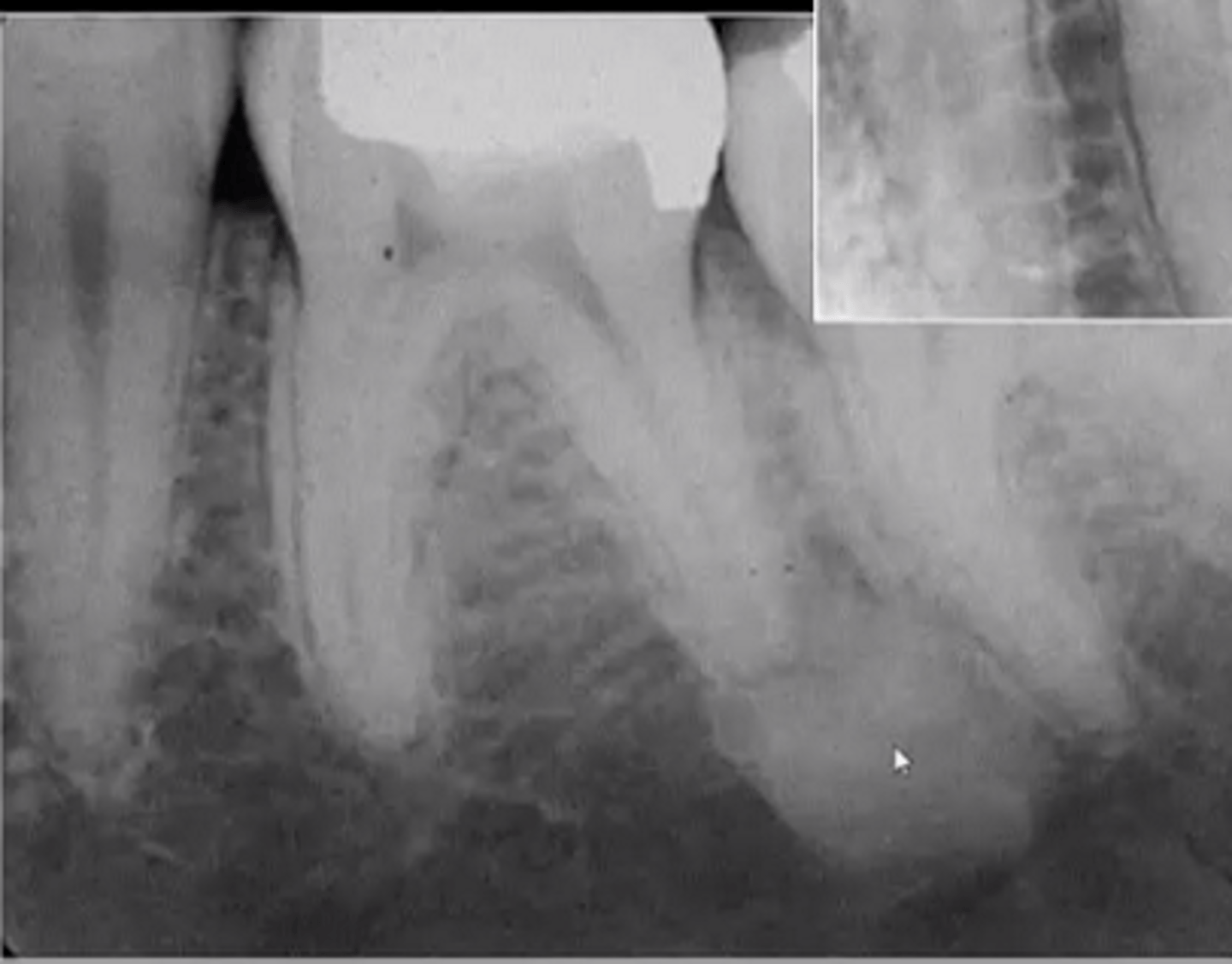 <p>increased radiopacity</p><p>well-defined margins</p>