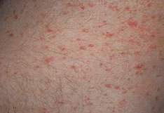 <p>can be contagious </p>