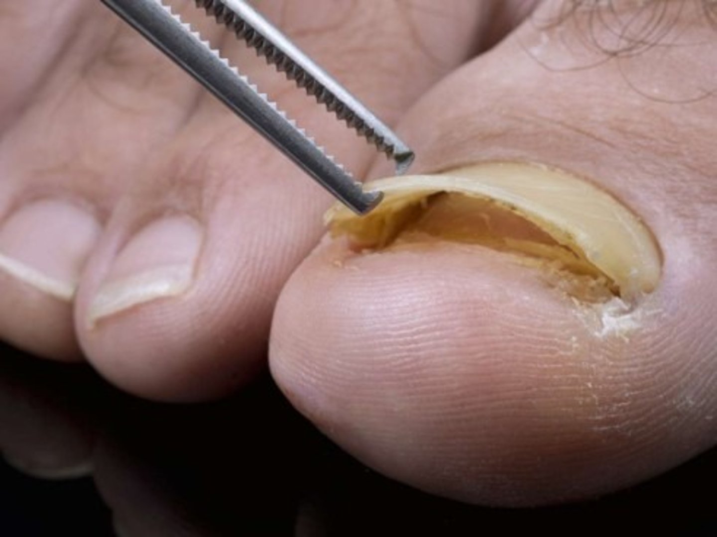 <p>Separation of the nail plate from the nail bed, the nail will eventually fall off</p><p>Causes:</p><p>-Hyperthyroidism</p><p>-Warts</p><p>-Psoriasis</p><p>-Onychomycosis (fungal infection)</p>