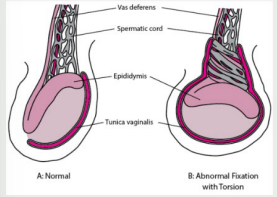 <p><strong>Testicular Torsion</strong></p><p>-Excruciating ________ pain in testicle of _______ onset, often during sleep or following trauma; may also have lower abdominal pain, _______, and vomiting </p><p>-Inspection → red, swollen __________, one testis (usually left) is ________ due to rotation and shortening (known as the ____-______ deformity)</p><p>-Palpation → spermatic cord feels _____, swollen, and tender. Epididymis may be anterior</p><p>-Cremasteric reflex ________ on side of torsion</p>